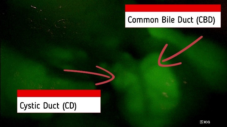 Visualizzazione intra-operatoria con fluorescenza ICG: identificazione del dotto cistico (CD) e della via biliare principale (CBD)