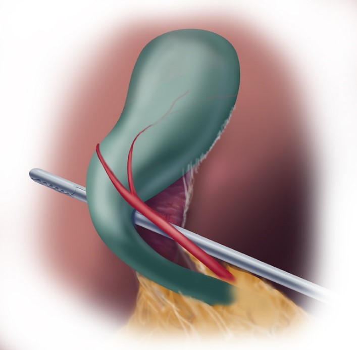 Illustrazione anatomica della colecisti e del triangolo di Calot, con strumento laparoscopico in fase di dissezione