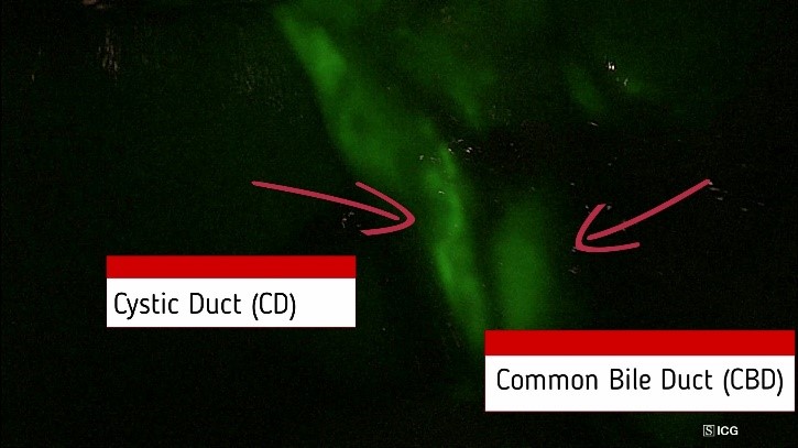 Visualizzazione intra-operatoria con fluorescenza ICG: dotto cistico e via biliare principale evidenziati dalla fluorescenza